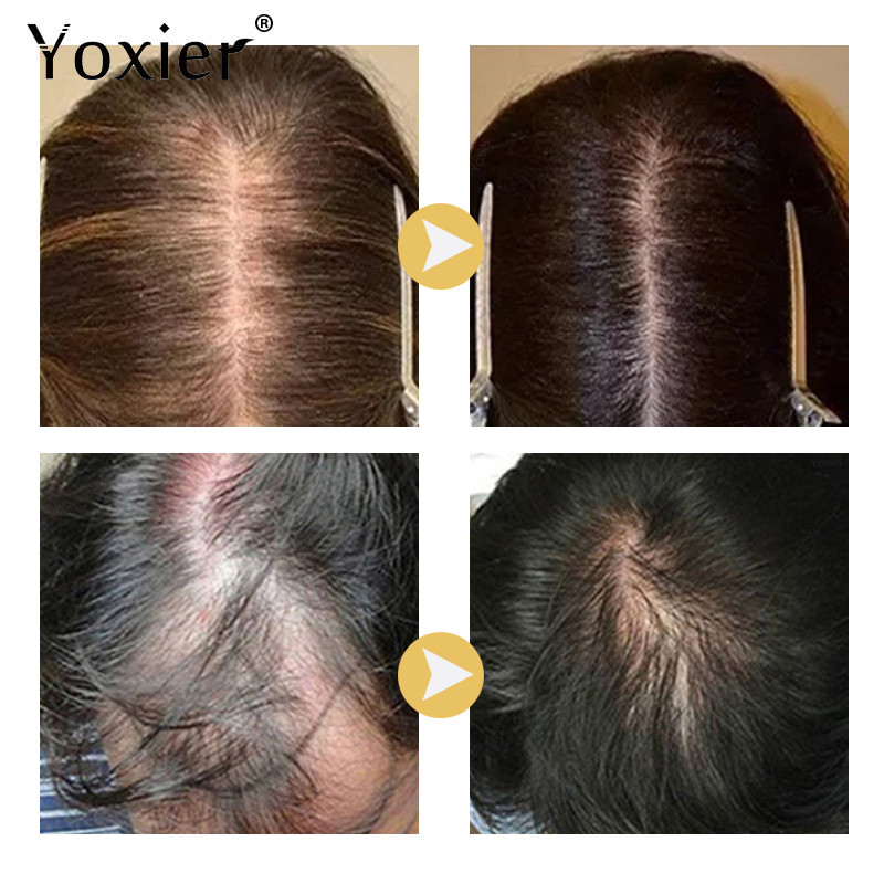 Intensive Growth Serum Prevent - Hair Care For Hair Growth review and price